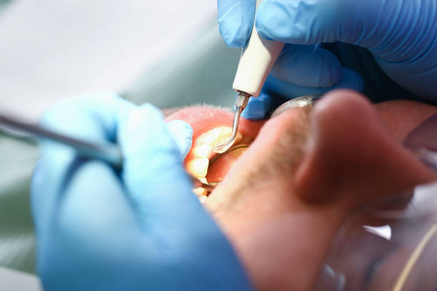 Best Emergency Wisdom Teeth Removal in Henderson, GA